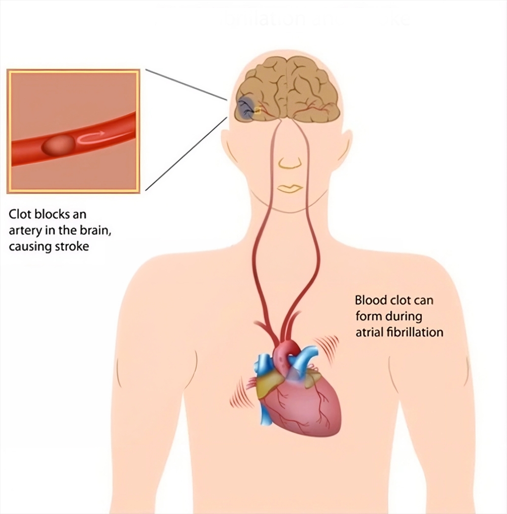 Atrial fibrillation.